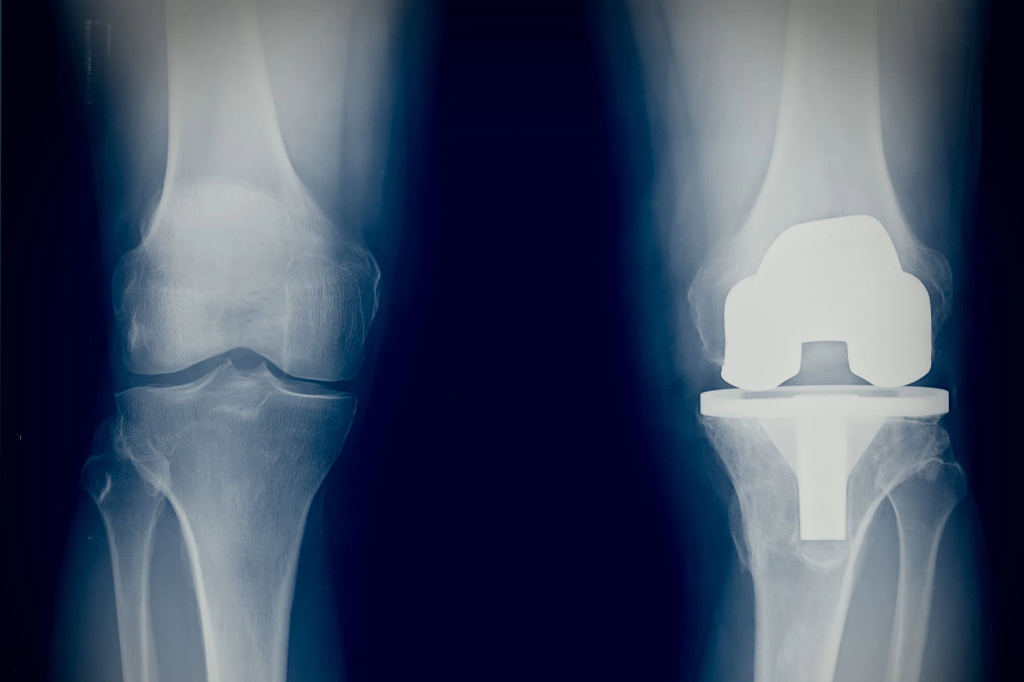 Endoprothetik am KaDeWe Berlin – Knie- und Hüftgelenkersatz